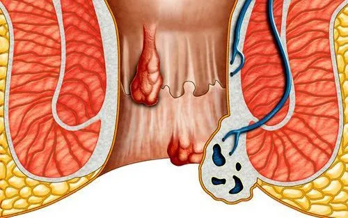 Giãn mạch máu ở hậu môn trực tràng gây bệnh trĩ