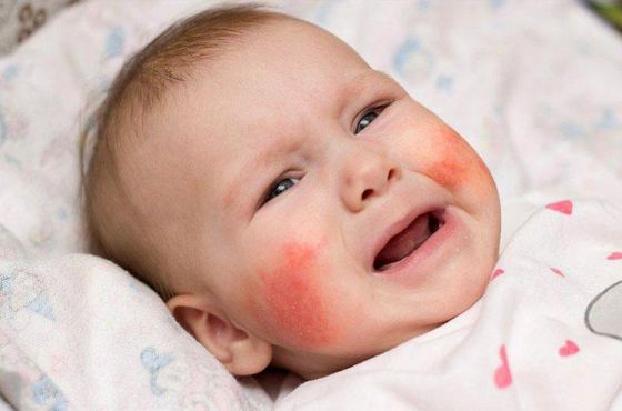 Trẻ nhỏ bị dị ứng thời tiết phải làm sao?