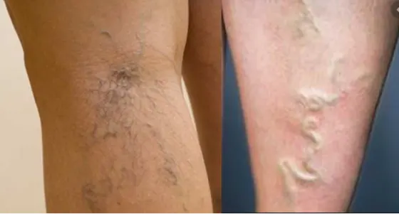 Giãn tĩnh mạch mạng nhện và suy giãn tĩnh mạch