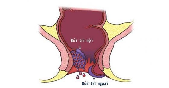 Bệnh trĩ
