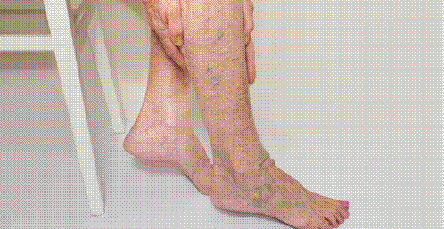 Hình ảnh suy giãn tĩnh mạch chi dưới