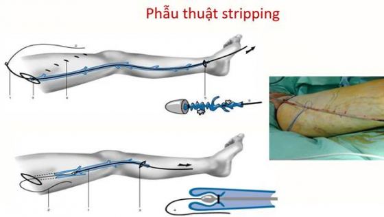 Phương pháp phẫu thuật Stripping điều trị suy van tĩnh mạch chi dưới