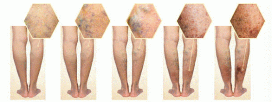 Nếu không điều trị, bệnh sẽ tiến triển nhanh chóng trở nên khó điều trị