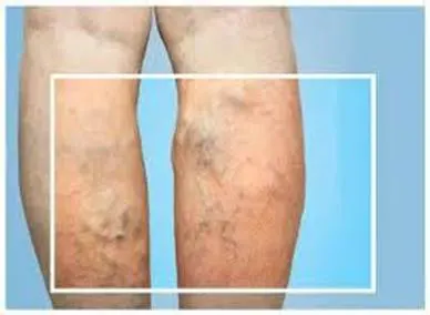 Bệnh lý suy giãn tĩnh mạch chân
