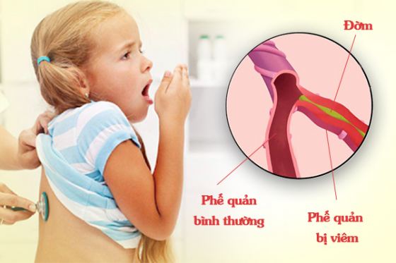 Phòng ngừa viêm phế quản ở trẻ nhỏ thời điểm giao mùa bằng cách nào?