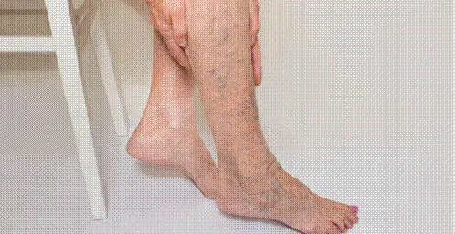 Hình ảnh suy giãn tĩnh mạch chi dưới