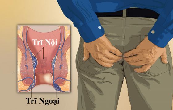 Phân loại bệnh trĩ