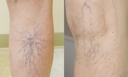 Giãn tĩnh mạch mạng nhện rất dễ nhận biết