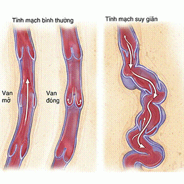 Suy giãn tĩnh mạch chân là bệnh gì?