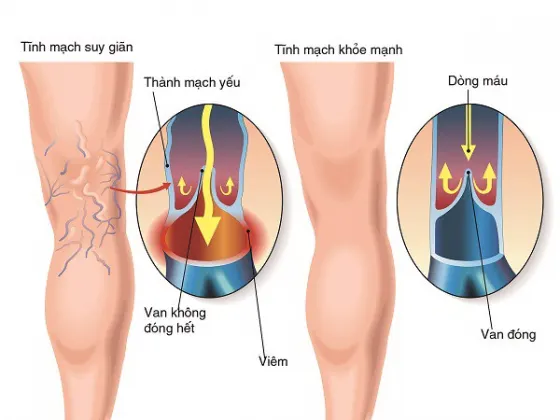 Van hư hại, thành mạch suy yếu làm suy giãn tĩnh mạch