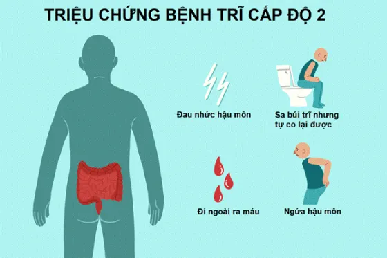 Triệu chứng bệnh trĩ cấp độ 2