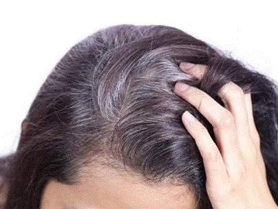 Tóc bạc sớm là tình trạng như thế nào?
