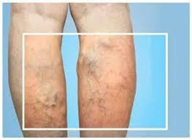 Bệnh lý suy giãn tĩnh mạch chân