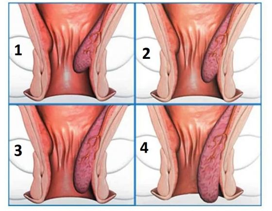 4 Cấp độ của bệnh trĩ nội