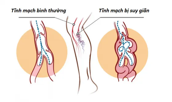 Suy giãn tĩnh mạch sâu là bệnh gì?