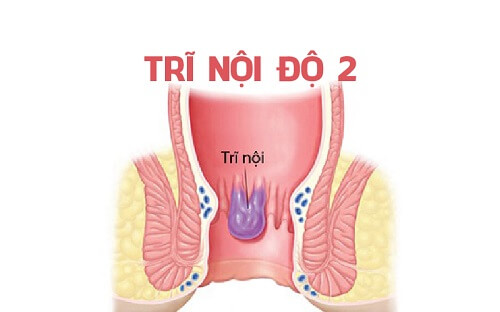 Trĩ nội độ 2 là gì?