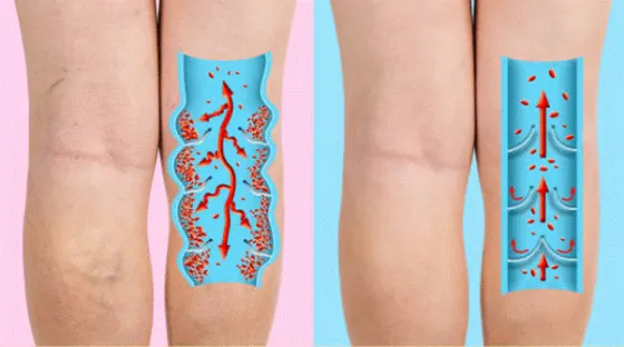 Dòng máu trong bệnh suy giãn tĩnh mạch và ở người bình thường