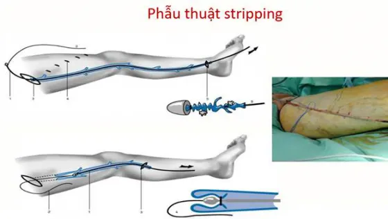 Phương pháp phẫu thuật Stripping điều trị suy van tĩnh mạch chi dưới