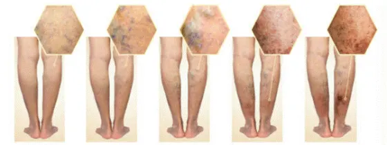 Nếu không điều trị, bệnh sẽ tiến triển nhanh chóng trở nên khó điều trị