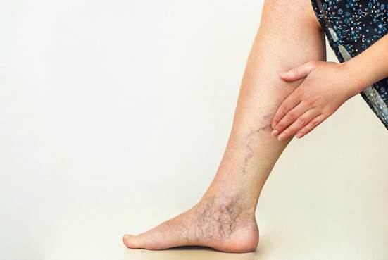 Hình ảnh thường gặp ở người bệnh suy giãn tĩnh mạch chân