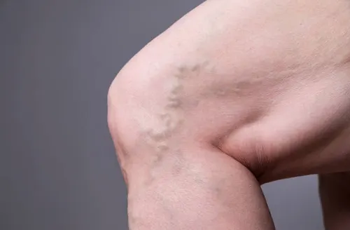 Suy giãn tĩnh mạch nông chi dưới là bệnh gì?
