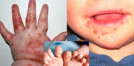 3 dấu hiệu cảnh báo bệnh tay chân miệng của trẻ đang ở giai đoạn nặng?