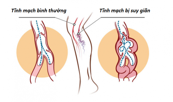 Suy giãn tĩnh mạch sâu là bệnh gì?