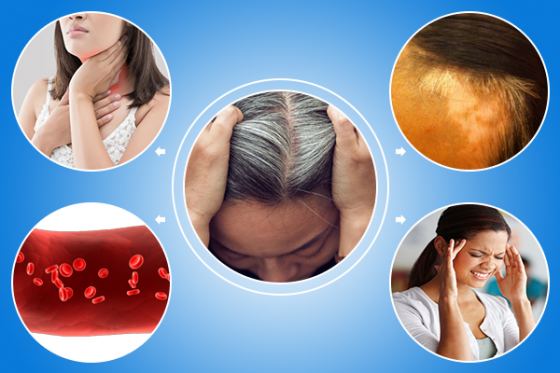 Tóc bạc sớm là bệnh gì?