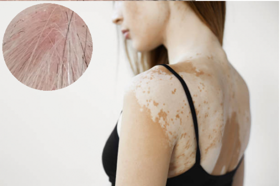 Bệnh bạch biến khiến da và tóc đều có màu trắng bạc