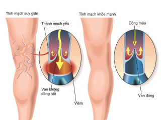 Triệu chứng suy giãn tĩnh mạch là gì? Giải pháp tối ưu cải thiện suy giãn tĩnh mạch
