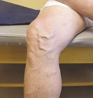 Hỏi: Dùng BoniVein trong thời gian bao lâu thì ngưng?