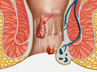 Bệnh trĩ nội là gì? Tổng quan từ a-z (2020)