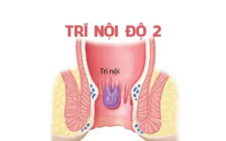 Những cách ch-ữa trĩ nội độ 2 tại nhà hiệu quả