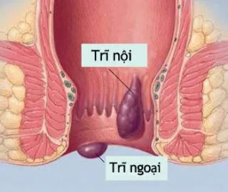 Những ước mơ giản dị của người bệnh trĩ