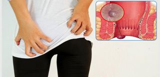 Bệnh trĩ ngoại: dấu hiệu nhận biết và cách trị tại nhà hiệu quả