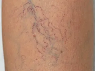 5 Nguyên nhân điển hình gây giãn mạch máu tĩnh mạch và cách khắc phục hiệu quả