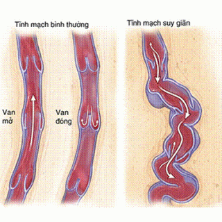 Suy giãn tĩnh mạch chân uống  gì? Biện pháp nào khắc phục hiệu quả?