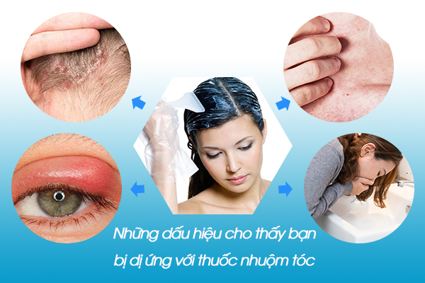 Những dấu hiệu cho thấy bạn bị dị ứng với thuốc nhuộm tóc