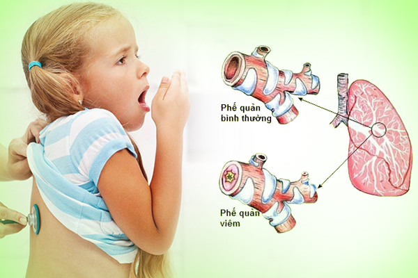 Trẻ bị viêm phế quản bao lâu thì khỏi?