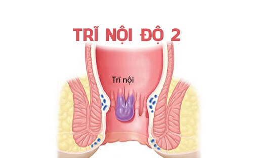 Những cách ch-ữa trĩ nội độ 2 tại nhà hiệu quả