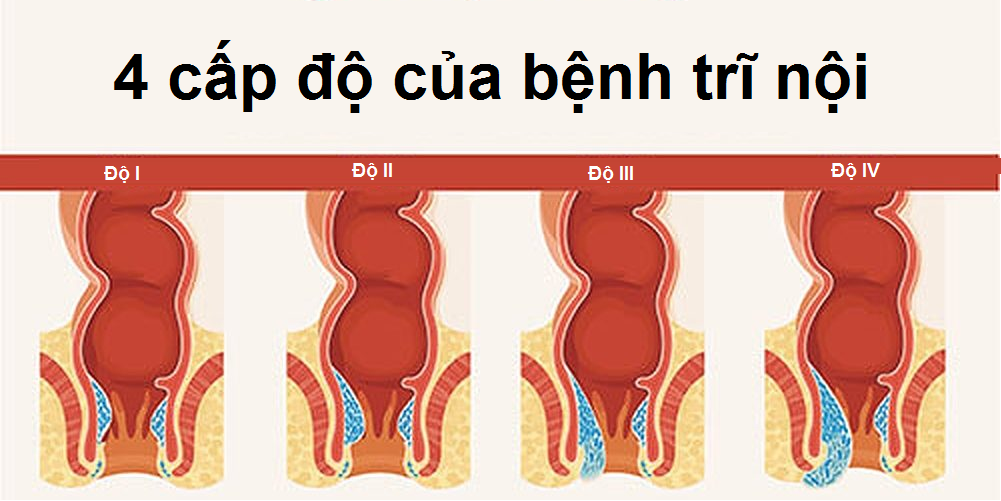 Các cấp độ của bệnh trĩ nội