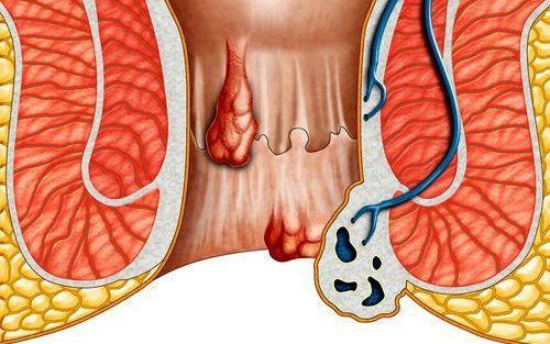 Giãn mạch máu ở hậu môn trực tràng gây bệnh trĩ