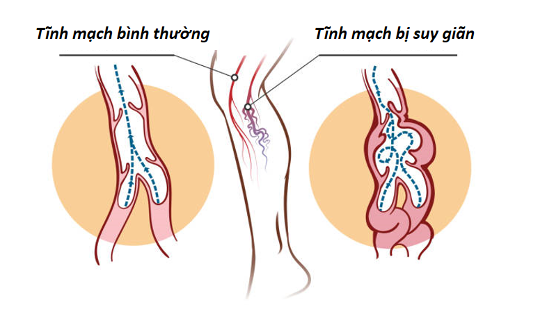 Cảnh báo những hậu quả khôn lường do suy giãn tĩnh mạch sâu gây ra