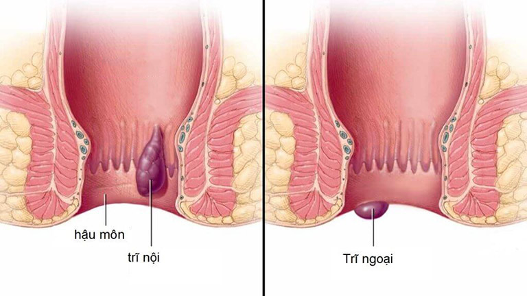 Bệnh trĩ nội và bệnh trĩ ngoại