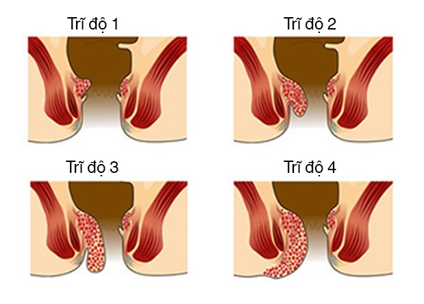 4 Cấp độ của bệnh trĩ nội