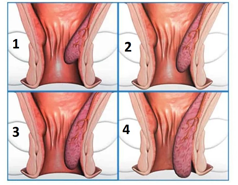 4 Cấp độ của bệnh trĩ nội