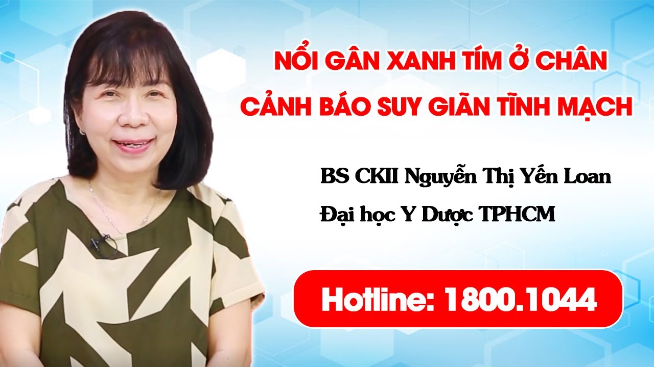 THVL1 - Nổi gân xanh tím ở chân - Triệu chứng cảnh báo căn bệnh suy giãn tĩnh mạch nguy hiểm