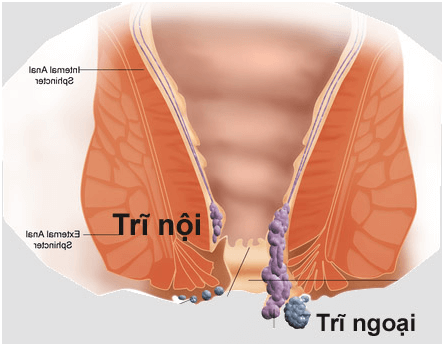 Cách hỗ trợ điều trị trĩ nội độ 3 hiệu quả