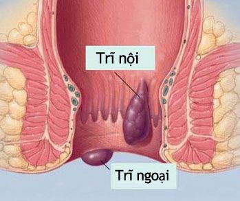 Những ước mơ giản dị của người bệnh trĩ